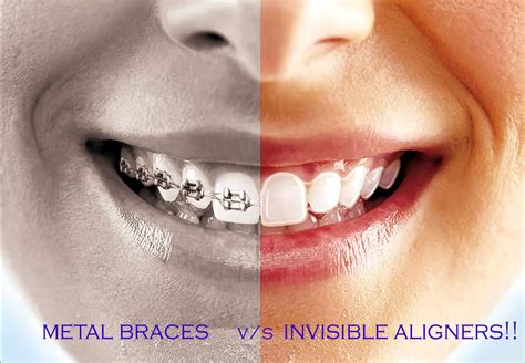 clear brackets vs metal|difference between aligners and braces.